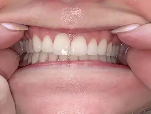 center teeth together