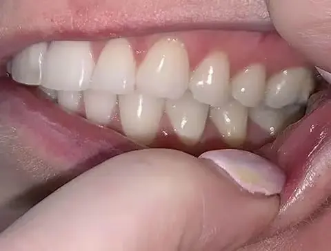 left side smile