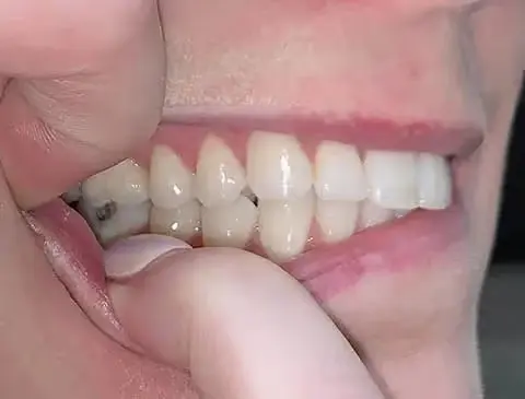 right side smile